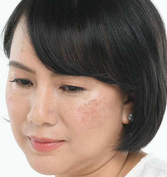 Pigmentation treatemnt by Pure Wellness Clinic