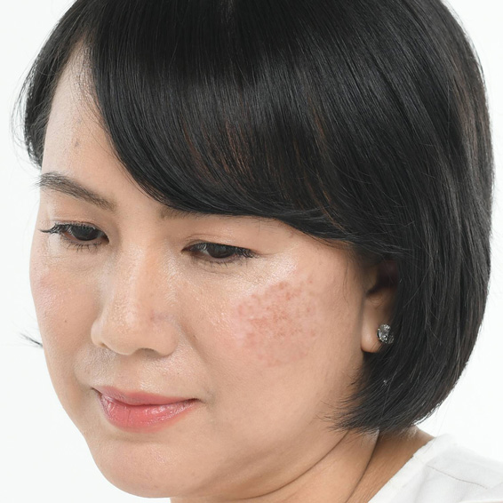 Pigmentation treatemnt by Pure Wellness Clinic